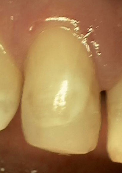 Dens In Dente Lateral Incisor