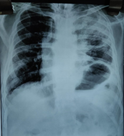 Invasive Candidiasis With Cavitary Lung Lesion In A Post-covid-19 ...