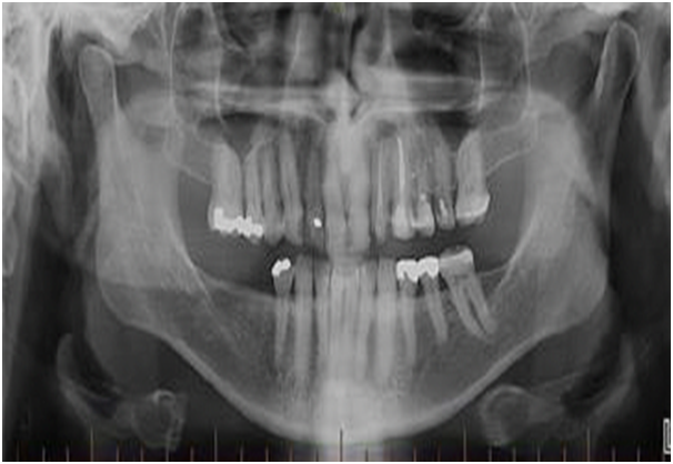 Case Series: Use of Coralline Hydroxyapatite Graft in Faciomaxillary ...