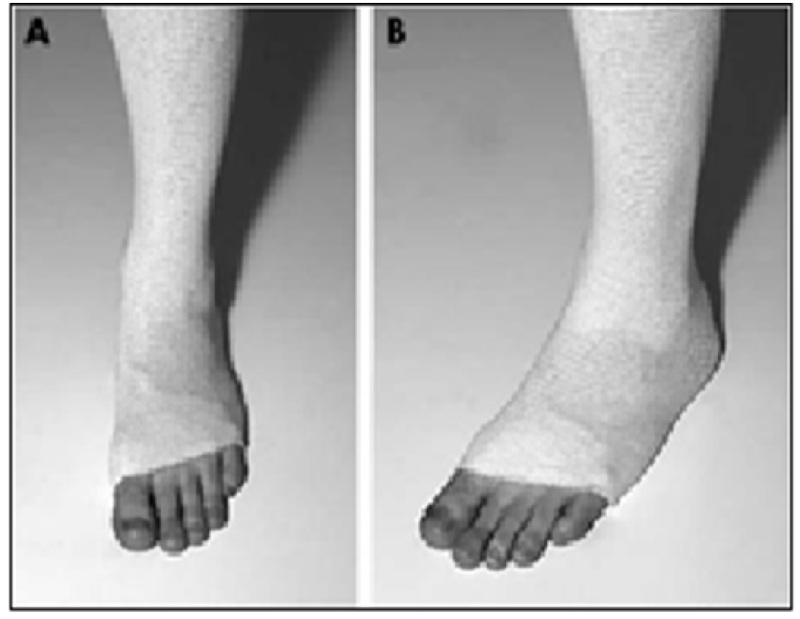 Post Recovery Surgical High Elastic Custom Leg Ankle Half MID Calf
