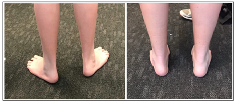 Flexible Pes Planovalgus (Flexible Flatfoot) - Pediatrics