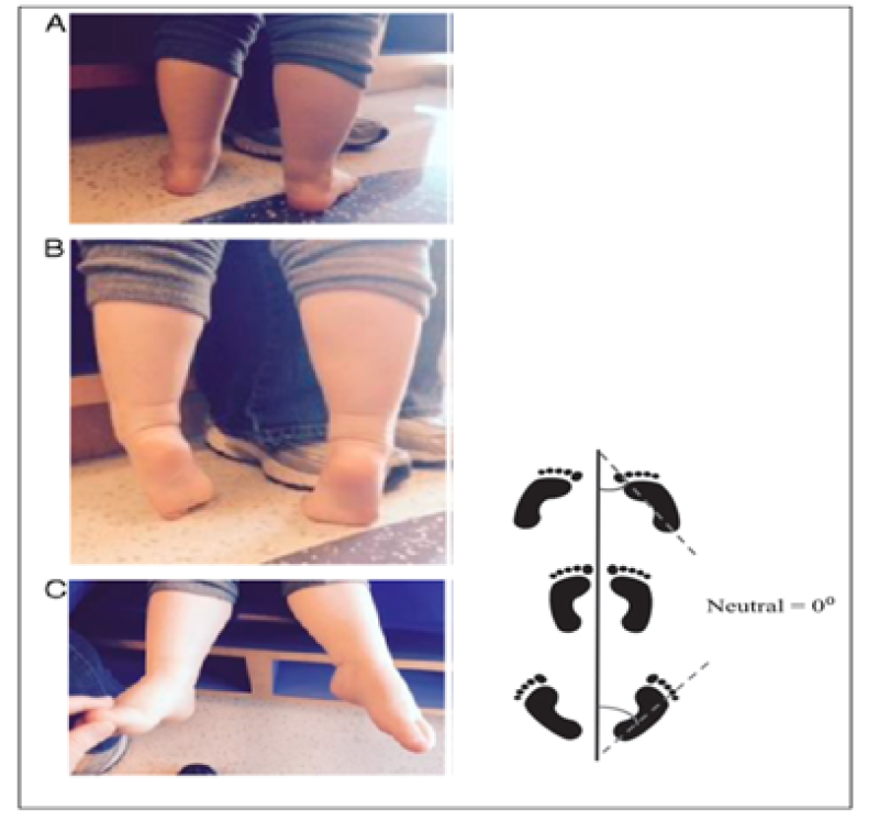 Jack's toe-raising test. An arch is created in a flexible flatfoot