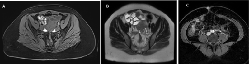 Primary Umbilical Endometriosis Case Report 