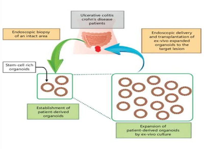 Stem Cell Biology on Autoimmune Disease-Crohn’s Disease, Complex