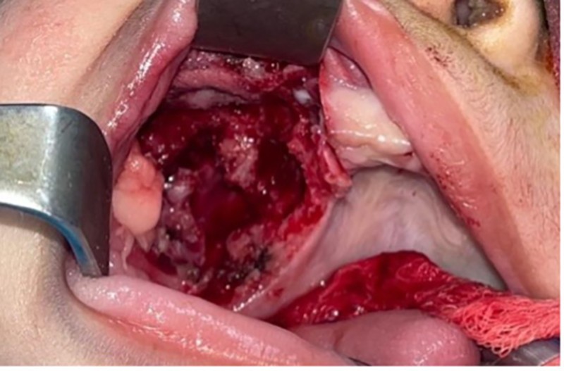 melanotic neuroectodermal tumor Melanotic neuroectodermal tumor of infancy: Review of literature, report of  a case and follow up at 7 years main image 0